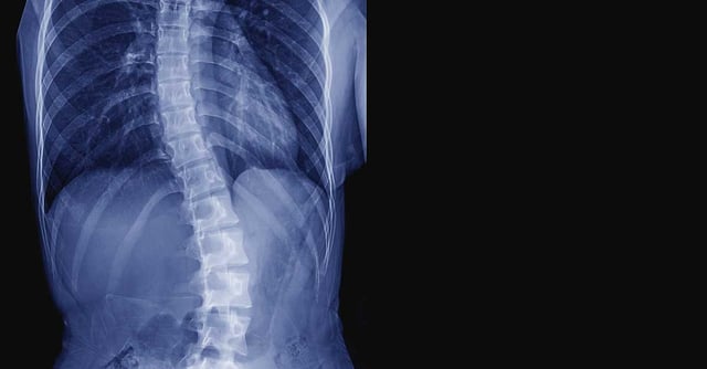 FI_Scoliosis